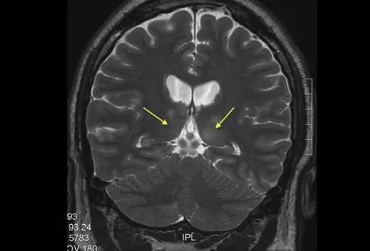 颅内感染诊断的关键影像学检查：特定病原感染