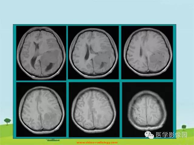 【病例】侧脑室脑膜瘤1例CT及MR影像表现 【病例】侧脑室脑膜瘤1例CT及MR影像表现