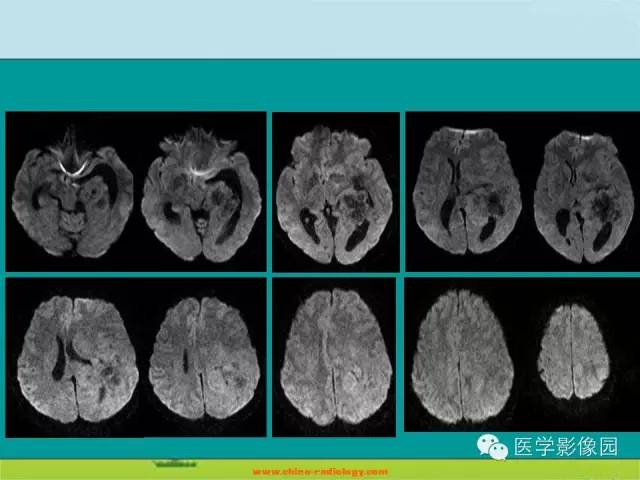 【病例】侧脑室脑膜瘤1例CT及MR影像表现 【病例】侧脑室脑膜瘤1例CT及MR影像表现