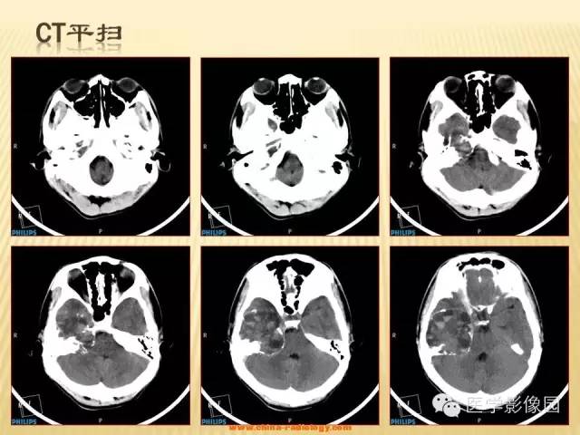 【病例】三叉神经鞘瘤1例CT及MR影像表现 【病例】三叉神经鞘瘤1例CT及MR影像表现