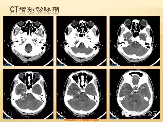 【病例】三叉神经鞘瘤1例CT及MR影像表现 【病例】三叉神经鞘瘤1例CT及MR影像表现