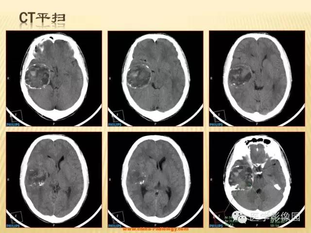 【病例】三叉神经鞘瘤1例CT及MR影像表现 【病例】三叉神经鞘瘤1例CT及MR影像表现