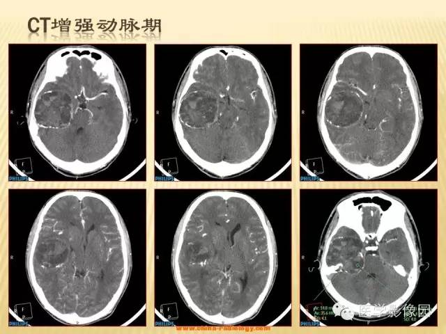 【病例】三叉神经鞘瘤1例CT及MR影像表现 【病例】三叉神经鞘瘤1例CT及MR影像表现