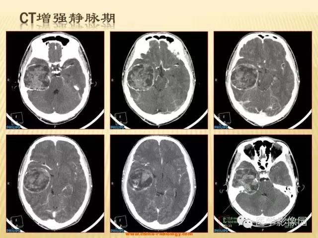 【病例】三叉神经鞘瘤1例CT及MR影像表现 【病例】三叉神经鞘瘤1例CT及MR影像表现