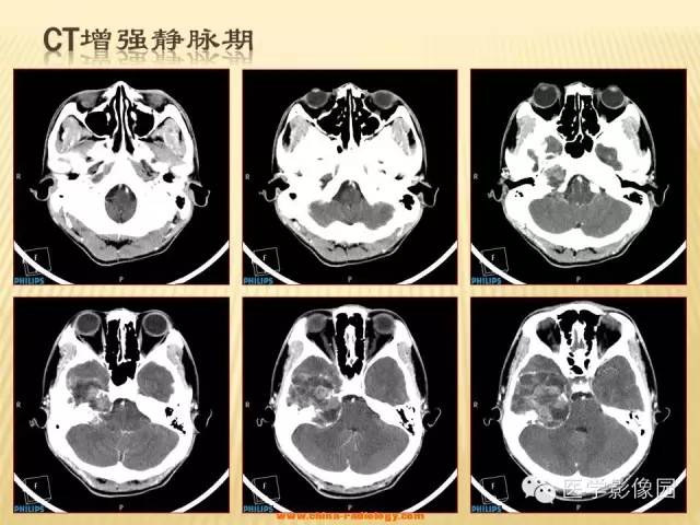 【病例】三叉神经鞘瘤1例CT及MR影像表现 【病例】三叉神经鞘瘤1例CT及MR影像表现