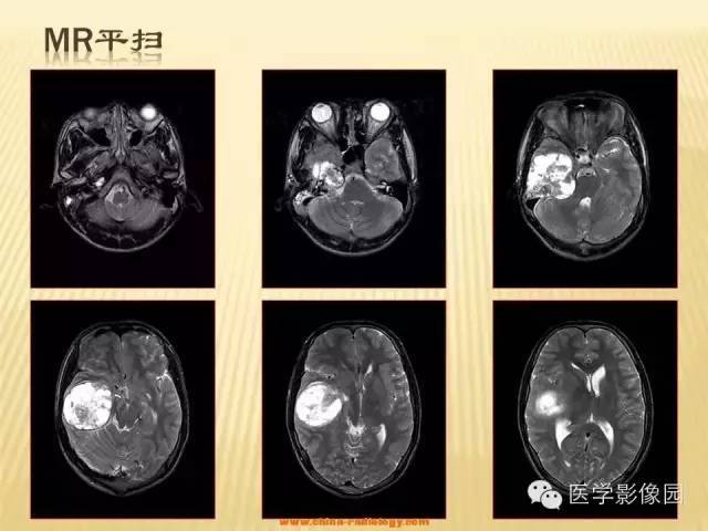 【病例】三叉神经鞘瘤1例CT及MR影像表现 【病例】三叉神经鞘瘤1例CT及MR影像表现