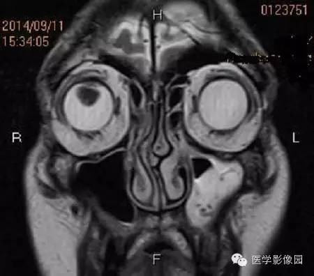 【病例】脉络膜黑色素瘤1例MR影像表现