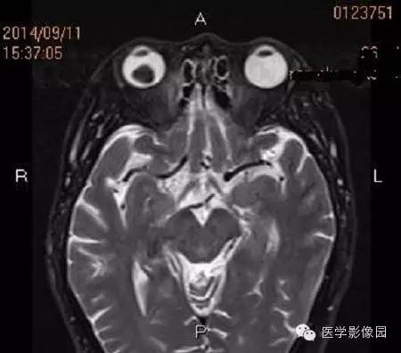 【病例】脉络膜黑色素瘤1例MR影像表现