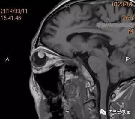 【病例】脉络膜黑色素瘤1例MR影像表现