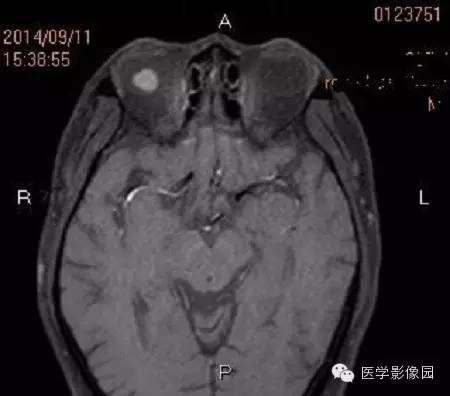 【病例】脉络膜黑色素瘤1例MR影像表现