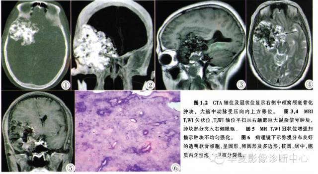 【病例】颅内软骨瘤1例影像表现