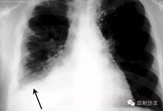 颅内感染诊断的关键影像学检查：特定病原感染