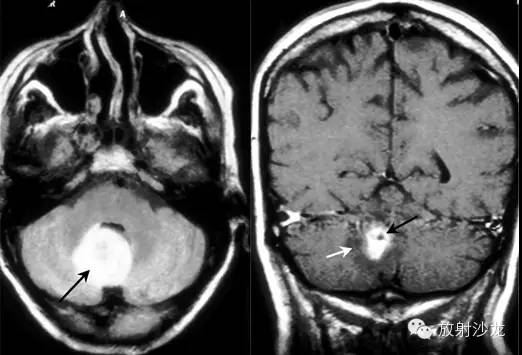 颅内感染诊断的关键影像学检查：特定病原感染