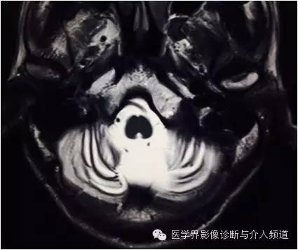 【病例】橄榄桥脑小脑萎缩1例MR影像表现 【病例】橄榄桥脑小脑萎缩1例MR影像表现