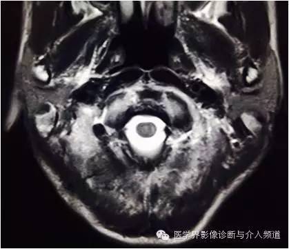 【病例】橄榄桥脑小脑萎缩1例MR影像表现