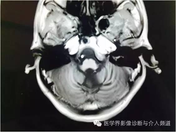 【病例】橄榄桥脑小脑萎缩1例MR影像表现 【病例】橄榄桥脑小脑萎缩1例MR影像表现