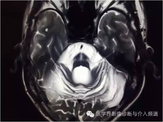 【病例】橄榄桥脑小脑萎缩1例MR影像表现 【病例】橄榄桥脑小脑萎缩1例MR影像表现