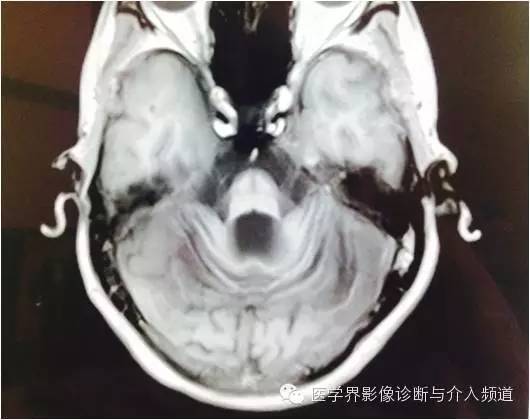 【病例】橄榄桥脑小脑萎缩1例MR影像表现 【病例】橄榄桥脑小脑萎缩1例MR影像表现