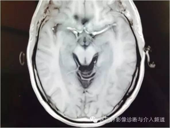 【病例】橄榄桥脑小脑萎缩1例MR影像表现 【病例】橄榄桥脑小脑萎缩1例MR影像表现