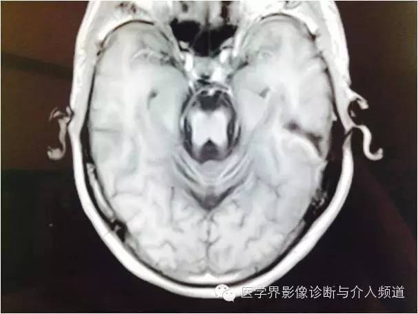 【病例】橄榄桥脑小脑萎缩1例MR影像表现 【病例】橄榄桥脑小脑萎缩1例MR影像表现