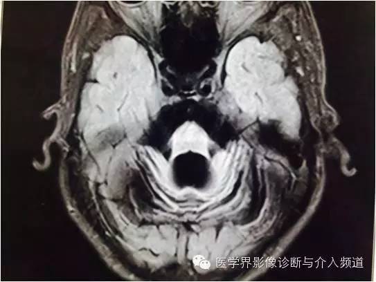 【病例】橄榄桥脑小脑萎缩1例MR影像表现 【病例】橄榄桥脑小脑萎缩1例MR影像表现