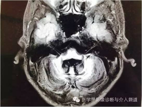 【病例】橄榄桥脑小脑萎缩1例MR影像表现 【病例】橄榄桥脑小脑萎缩1例MR影像表现