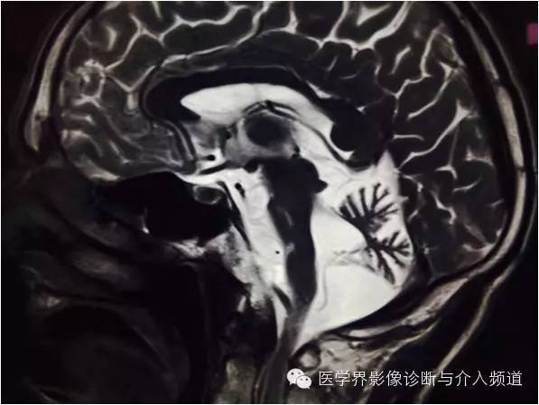 【病例】橄榄桥脑小脑萎缩1例MR影像表现 【病例】橄榄桥脑小脑萎缩1例MR影像表现