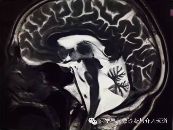 【病例】橄榄桥脑小脑萎缩1例MR影像表现 【病例】橄榄桥脑小脑萎缩1例MR影像表现