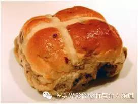 【病例】橄榄桥脑小脑萎缩1例MR影像表现 【病例】橄榄桥脑小脑萎缩1例MR影像表现