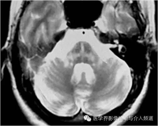 【病例】橄榄桥脑小脑萎缩1例MR影像表现 【病例】橄榄桥脑小脑萎缩1例MR影像表现