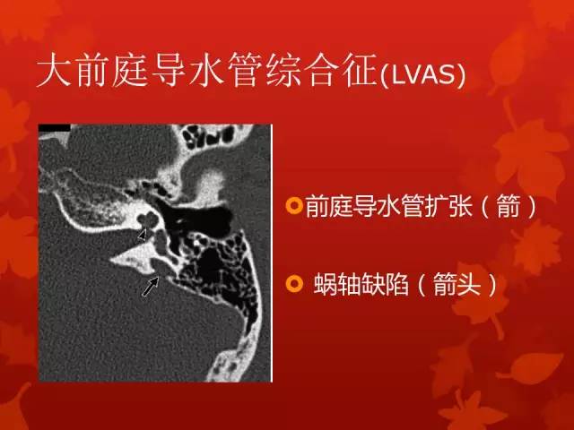 【病例】Mondini畸形一例CT影像表现