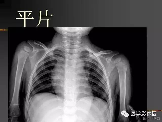 【病例】锁骨朗格汉斯细胞组织细胞增生症1例影像表现 【病例】锁骨朗格汉斯细胞组织细胞增生症1例影像表现