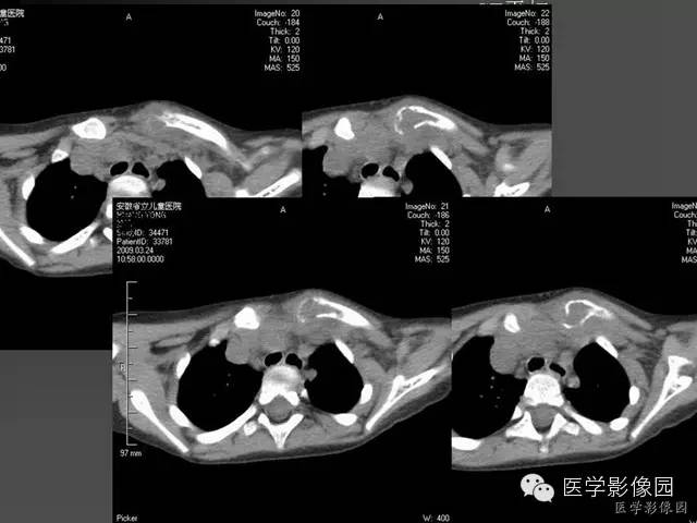 【病例】锁骨朗格汉斯细胞组织细胞增生症1例影像表现 【病例】锁骨朗格汉斯细胞组织细胞增生症1例影像表现