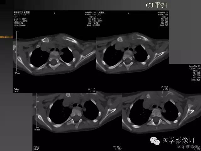 【病例】锁骨朗格汉斯细胞组织细胞增生症1例影像表现 【病例】锁骨朗格汉斯细胞组织细胞增生症1例影像表现