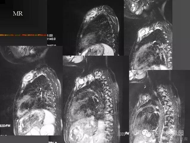 【病例】锁骨朗格汉斯细胞组织细胞增生症1例影像表现 【病例】锁骨朗格汉斯细胞组织细胞增生症1例影像表现