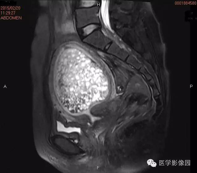 【病例】完全性葡萄胎1例MR影像表现