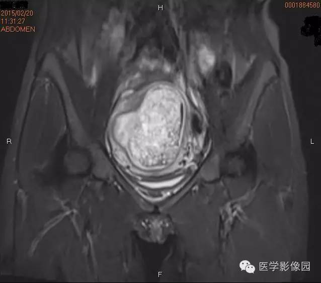 【病例】完全性葡萄胎1例MR影像表现 【病例】完全性葡萄胎1例MR影像表现