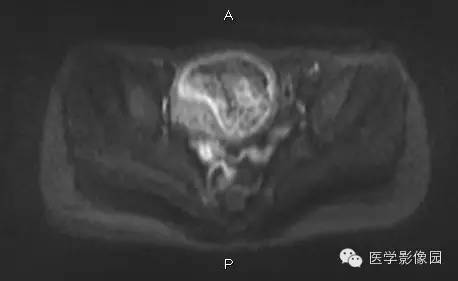 【病例】完全性葡萄胎1例MR影像表现 【病例】完全性葡萄胎1例MR影像表现