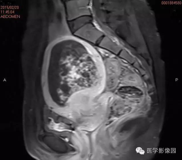 【病例】完全性葡萄胎1例MR影像表现 【病例】完全性葡萄胎1例MR影像表现