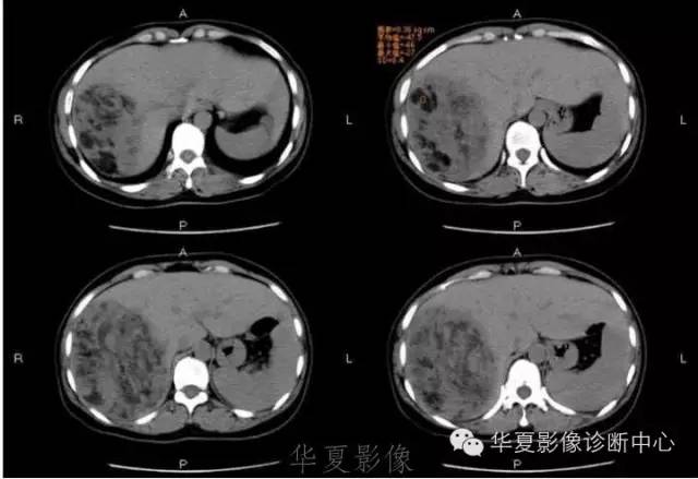 【病例】肝脏血管平滑肌脂肪瘤1例CT影像表现