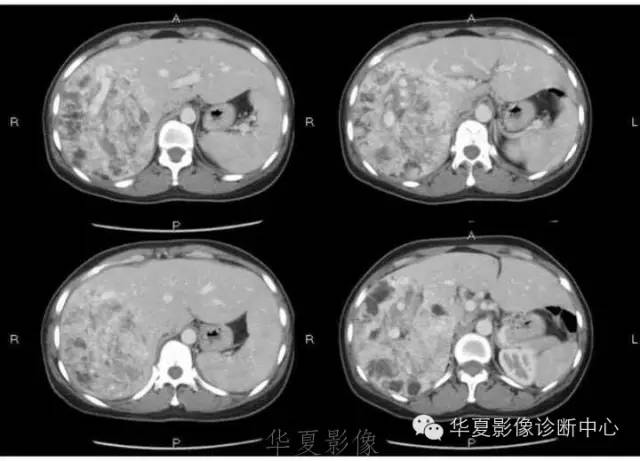 【病例】肝脏血管平滑肌脂肪瘤1例CT影像表现