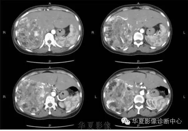 【病例】肝脏血管平滑肌脂肪瘤1例CT影像表现