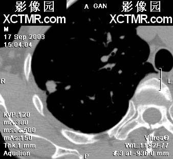 肺结节CT的征象及显示