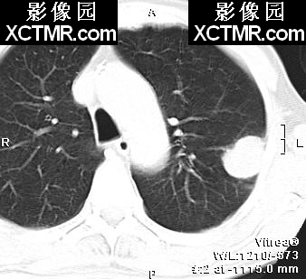 肺结节CT的征象及显示