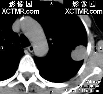 肺结节CT的征象及显示