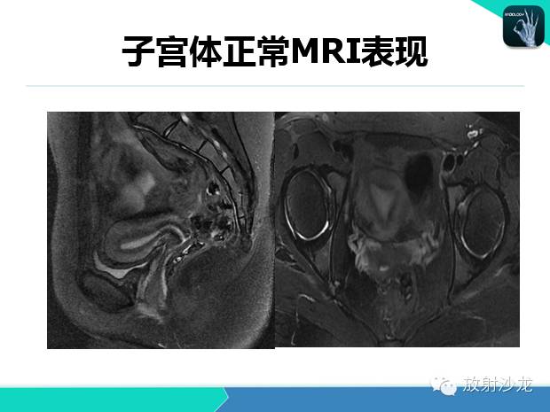 【PPT】宫颈癌MRI诊断在临床中的应用
