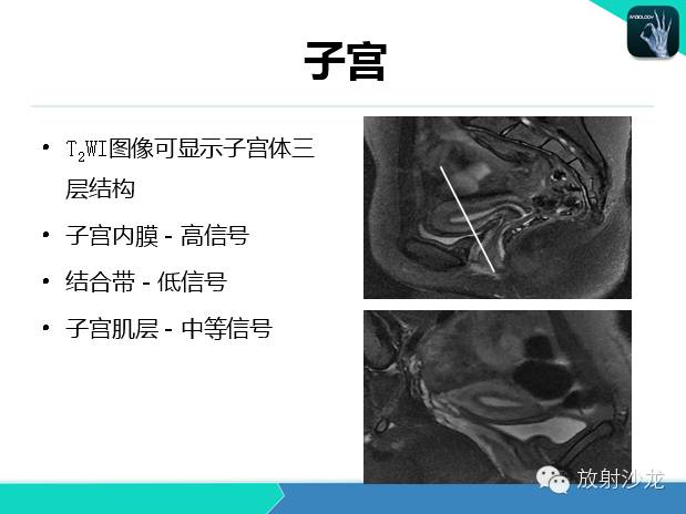 【PPT】宫颈癌MRI诊断在临床中的应用