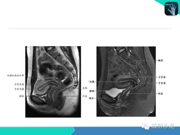 【PPT】宫颈癌MRI诊断在临床中的应用