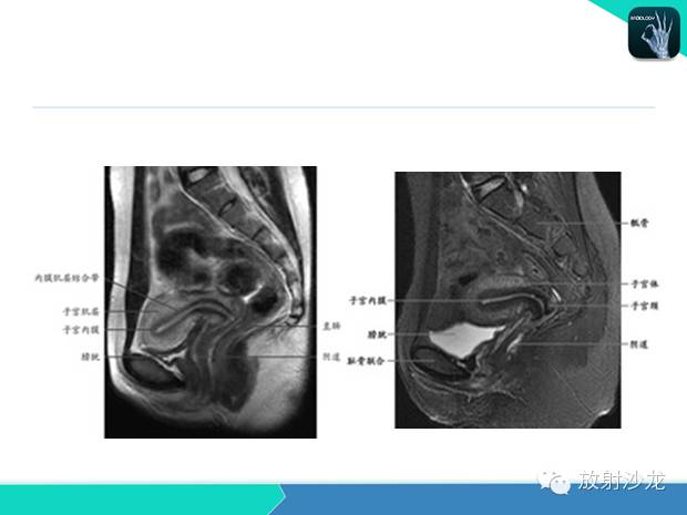 【PPT】宫颈癌MRI诊断在临床中的应用