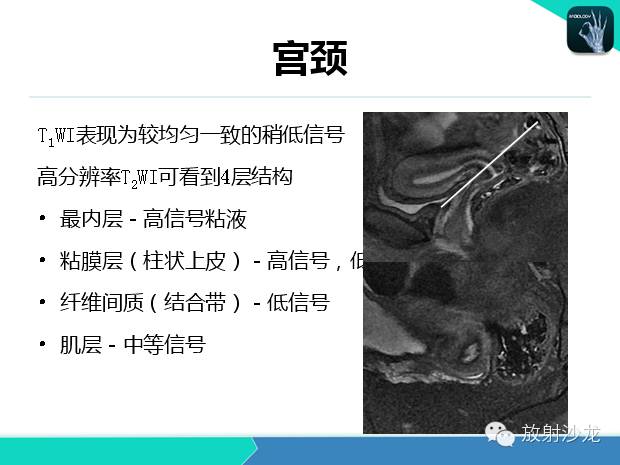 【PPT】宫颈癌MRI诊断在临床中的应用
